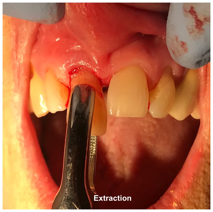 Extraction atraumatique