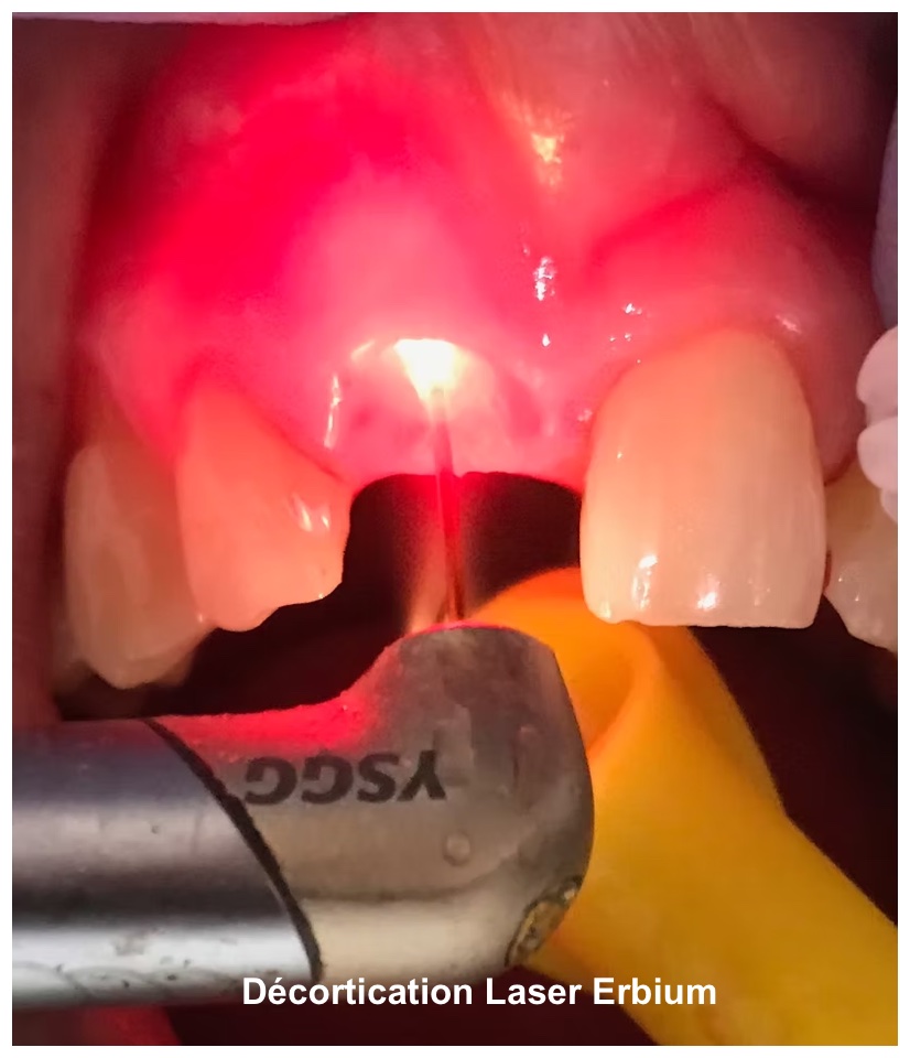 Décortication au laser Erbium