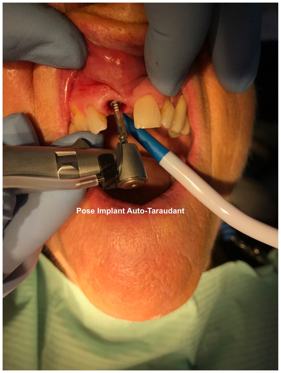 Pose de l'implant auto-taraudant