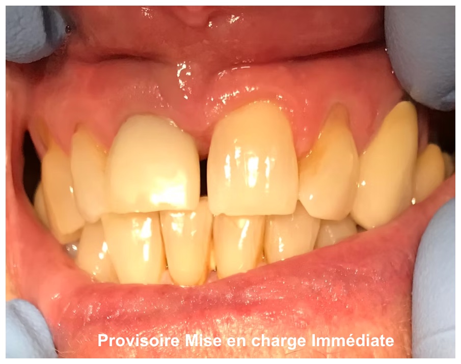 Provisoire, mise en charge immédiate